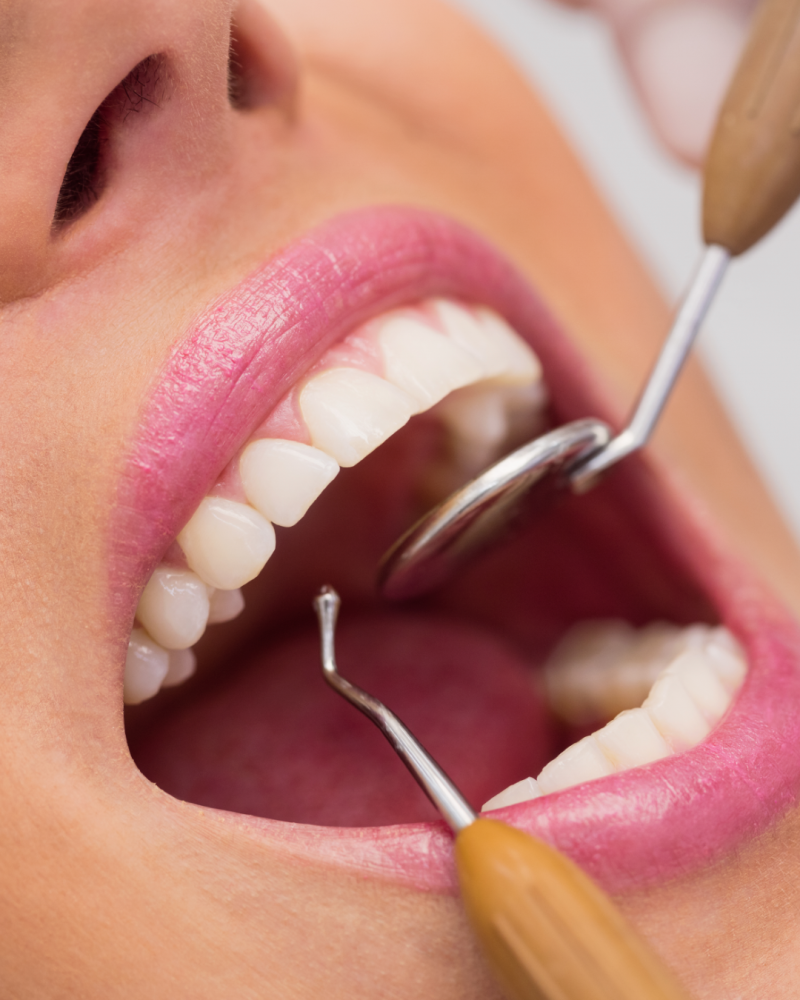 Limpieza dental
